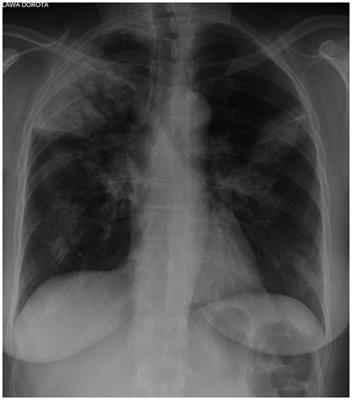Update on cryptogenic organizing pneumonia